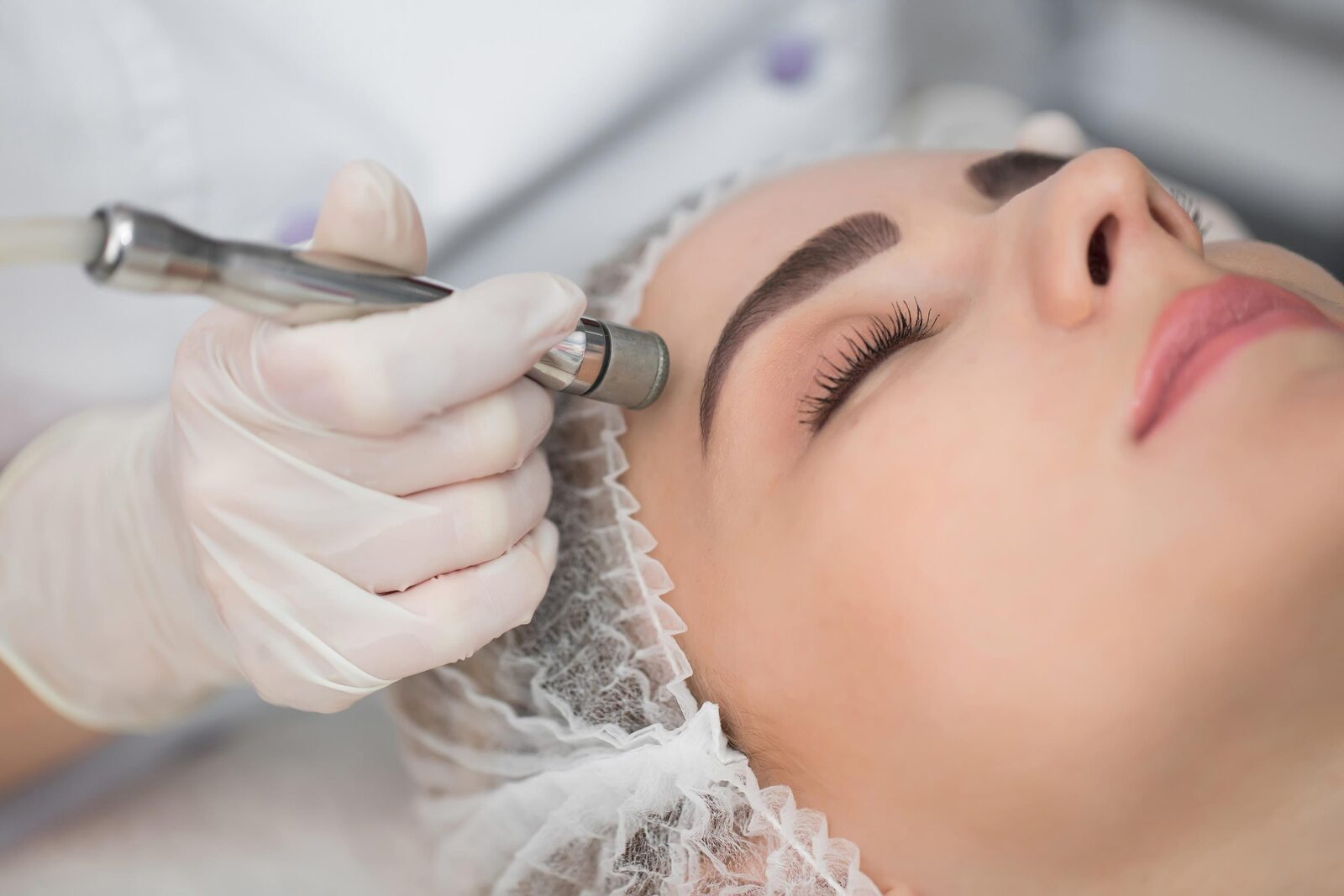 Mikrodermabrasion im Gesicht